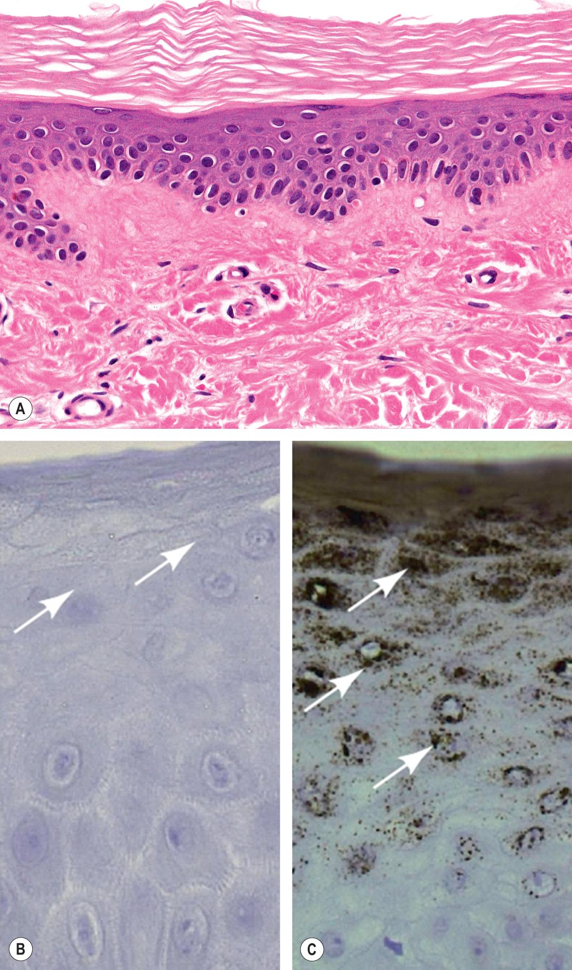 Fig. 57.4, Histologic features of ichthyosis vulgaris.