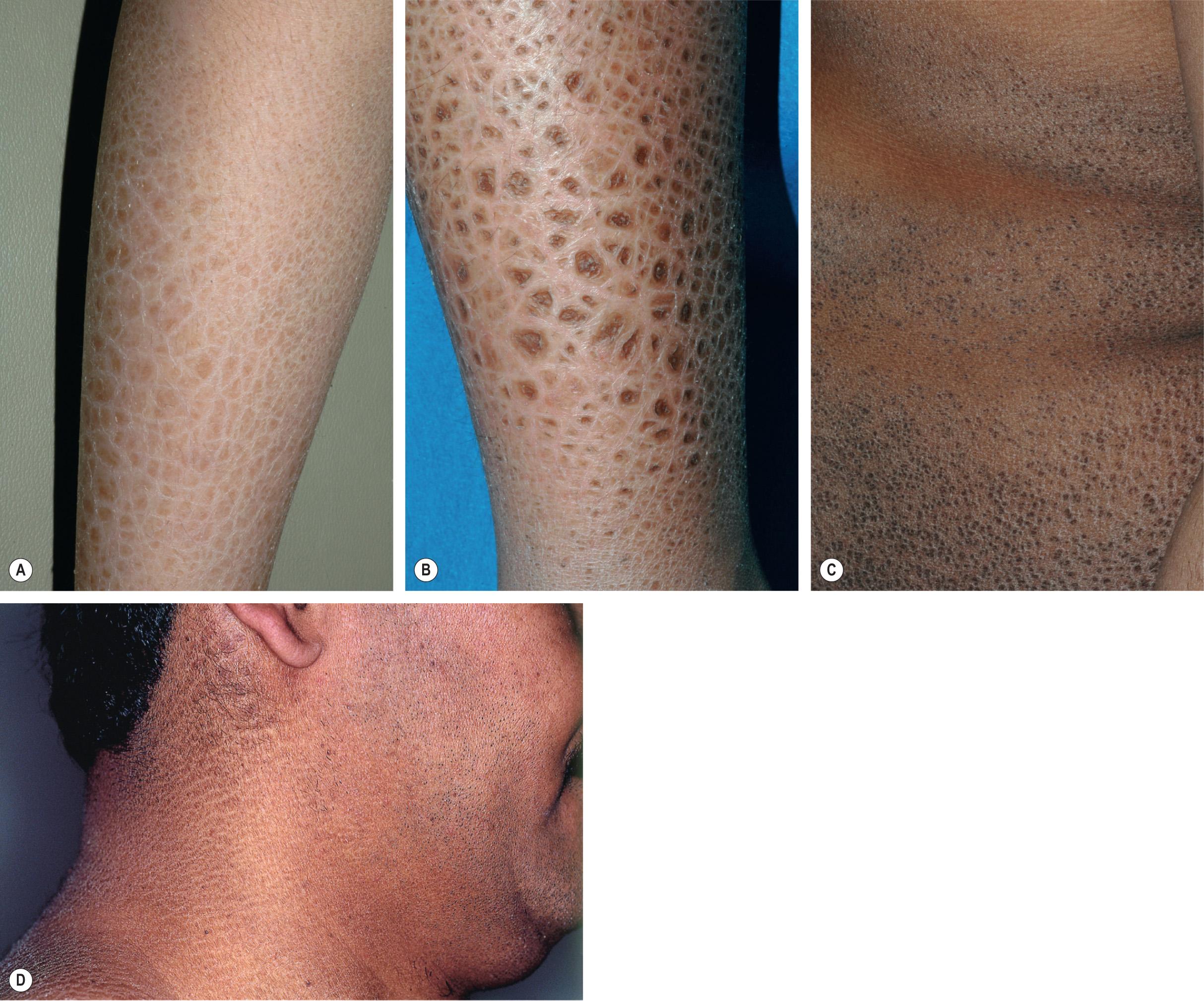 Fig. 57.5, Steroid sulfatase deficiency.