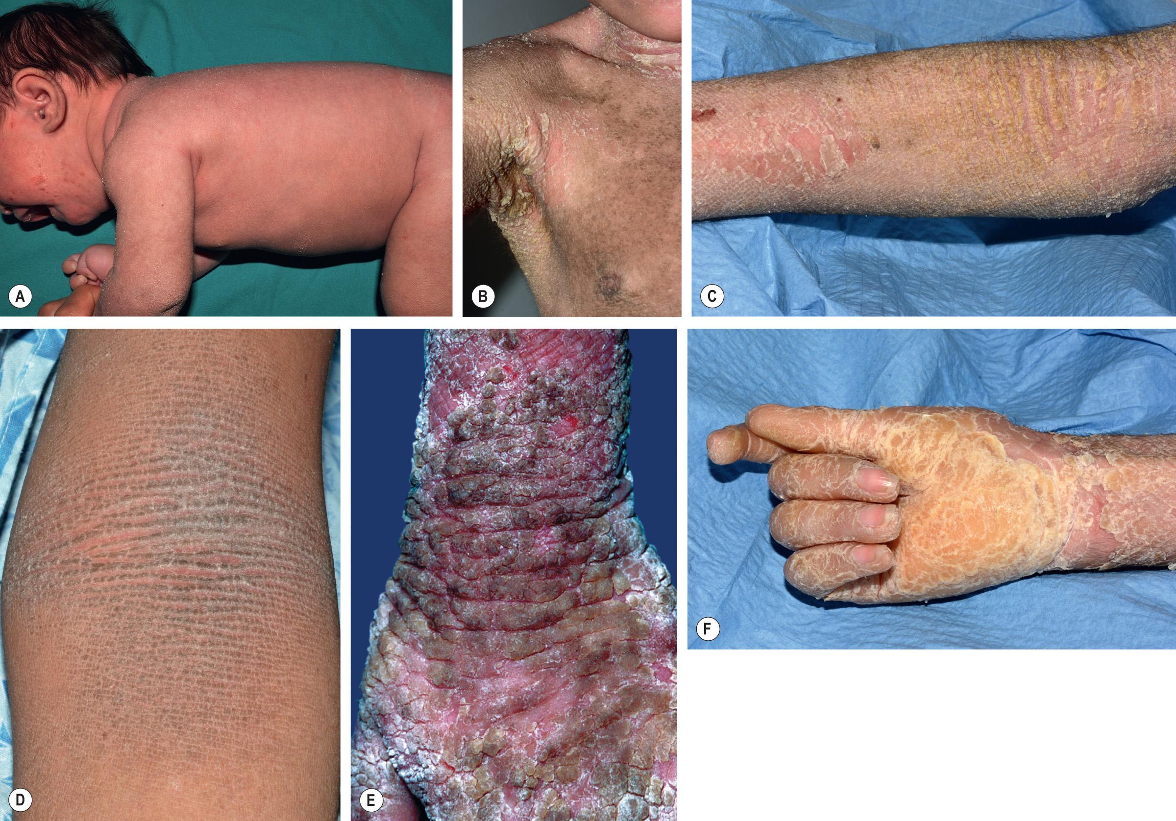 Fig. 57.6, Epidermolytic ichthyosis.