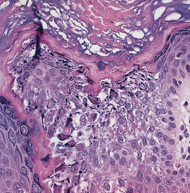 Fig. 57.7, Histology of epidermolytic ichthyosis.