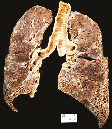 FIG. 16.1, Usual interstitial pneumonia. A gross specimen of right and left autopsy lungs cut in a coronal plane shows lower and middle lobe with fibrotic consolidation extending from the pleural surface. Honeycomb cysts are grossly apparent and resemble what would be seen on a CT scan.