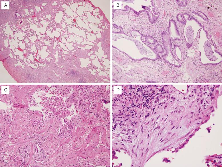 FIG. 16.2, Usual interstitial pneumonia. (A) At low power, UIP is characterized by its variegated appearance; areas of fibrosis alternate with areas of uninvolved lung. (B) Focally, microscopic honeycombing can be seen, which consists of lung fibrosis with no discernable alveolar units but retained airways, typically with inflammatory debris within the space. (C) Medium power often reveals foci of smooth muscle metaplasia within the fibrosis. (D) Fibroblastic foci, with fibromyxoid stroma and overlying attenuated epithelium, are usually found at the interface of dense fibrosis and normal lung.