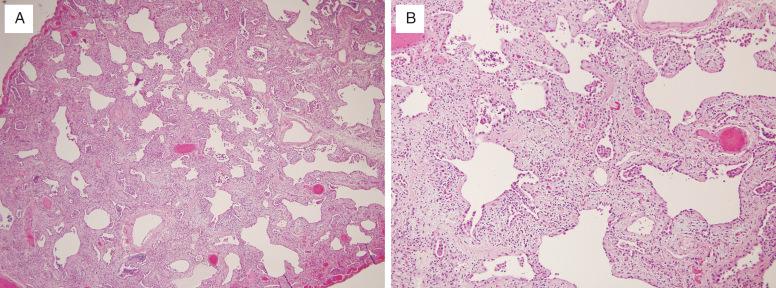 FIG. 16.5, Fibrosing nonspecific interstitial pneumonia pattern. Fibrosing NSIP pattern is characterized by temporally uniform interstitial fibrosis. The fibrotic alveolar septa may also contain chronic inflammatory cells.