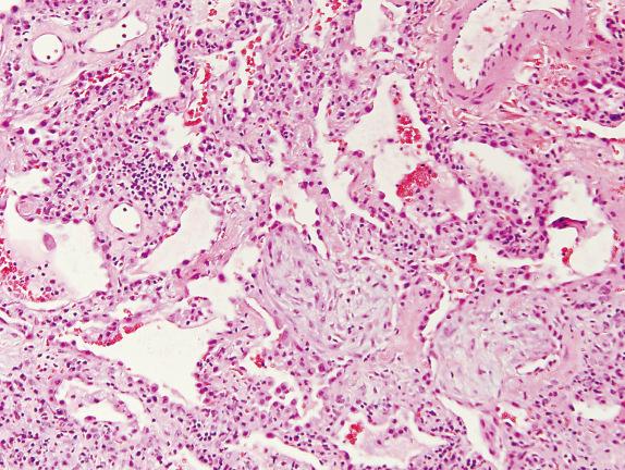 FIG. 16.6, Nonspecific interstitial pneumonia pattern with a minor component of organizing pneumonia. Organizing pneumonia with fibroblastic plugs may be a minor component of the NSIP pattern.