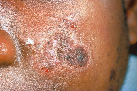 Fig. 17.12, Discoid lupus erythematosus: close-up view.