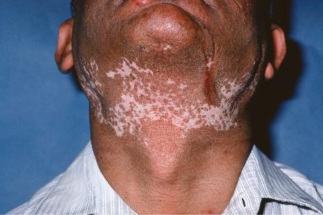 Fig. 17.13, Discoid lupus erythematosus: marked hypopigmentation may be a distressing complication.