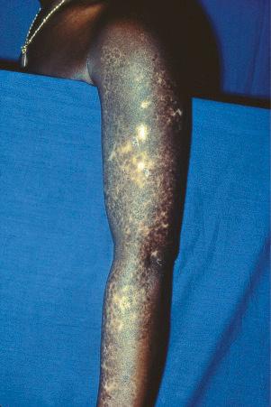 Fig. 17.14, Discoid lupus erythematosus: in this patient, the arm is severely affected.