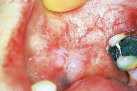 Fig. 17.16, Discoid lupus erythematosus: typical scarred lesion on the buccal mucosa.