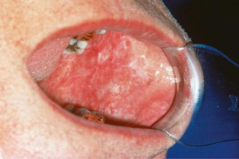 Fig. 17.17, Discoid lupus erythematosus: oral involvement is sometimes difficult to distinguish from lichen planus.