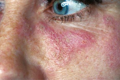 Fig. 17.2, Discoid lupus erythematosus: close-up view showing erythema and scale.