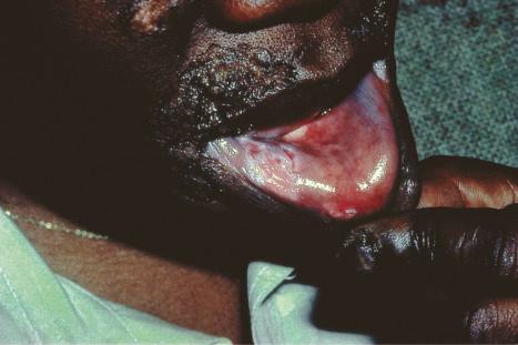 Fig. 17.19, Verrucous discoid lupus erythematosus: extensive disfiguring warty plaque involving the upper lip and angle of mouth.