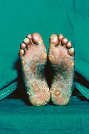 Fig. 17.20, Verrucous discoid lupus erythematosus: note the gross hyperkeratosis.