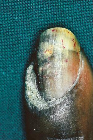 Fig. 17.21, Verrucous discoid lupus erythematosus: note the hypertrophic cuticle, pitting, and onycholysis.