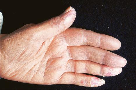 Fig. 17.26, Chilblain lupus erythematosus: resolving perniosis involving the tips of the thumb and ring and little fingers.