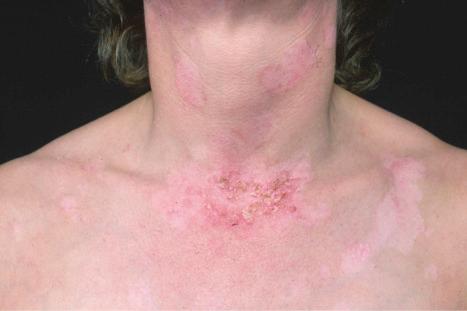 Fig. 17.27, Subacute cutaneous lupus erythematosus: annular lesions, many healed with pigmentary changes and delicate scale overlying an active lesion.