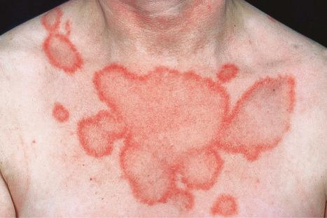 Fig. 17.28, Subacute cutaneous lupus erythematosus: coalescence of annular lesions has resulted in this bizarre eruption.