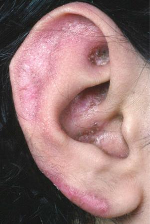 Fig. 17.3, Discoid lupus erythematosus: there is scaling and scarring on the ear lobe, a commonly affected site.