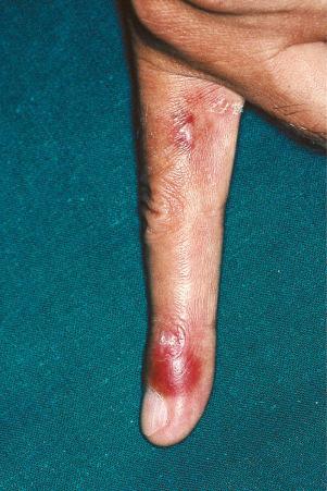 Fig. 17.32, Systemic lupus erythematosus: erythematous vasculitic lesion on the fingertip.