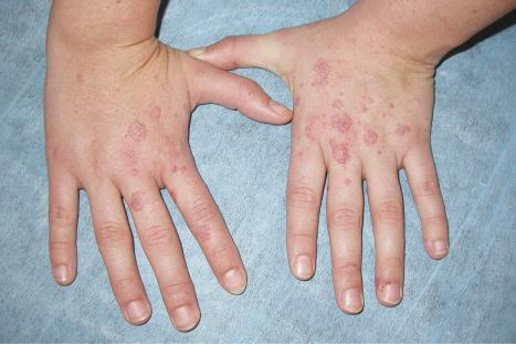 Fig. 17.34, Systemic lupus erythematosus: erythematous nodules are present on the back of the hand and on the fingers.