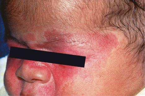 Fig. 17.37, Neonatal lupus erythematosus: in this child, there is intense erythema affecting the cheeks and nose and around the eyes.