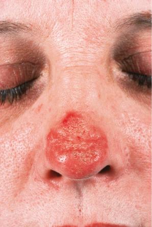 Fig. 17.4, Discoid lupus erythematosus: this severely affected patient shows healed ulceration with marked scarring and disfigurement.