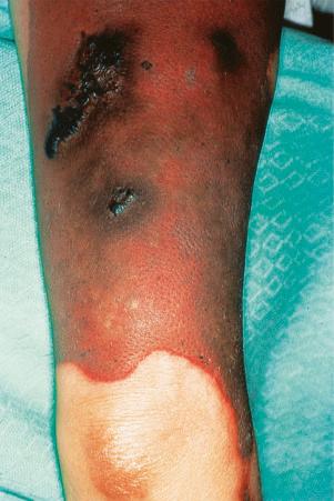 Fig. 17.43, Lupus anticoagulant syndrome: the leg was also involved.