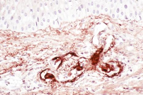 Fig. 17.44, Systemic lupus erythematosus: immunoperoxidase reaction demonstrating IgG within a blood vessel wall.