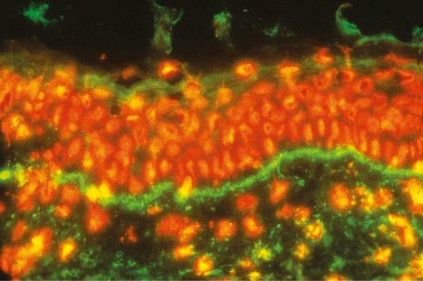 Fig. 17.45, Systemic lupus erythematosus: positive band test (IgG).