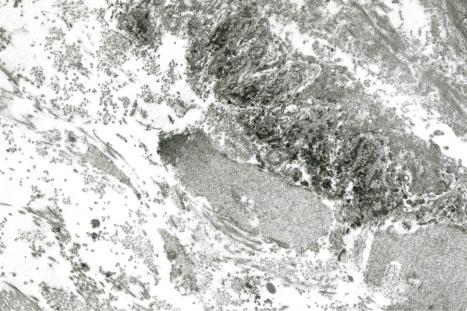 Fig. 17.46, Lupus band test: immunoelectron microscopy (frozen section) showing IgM deposition below the lamina densa.