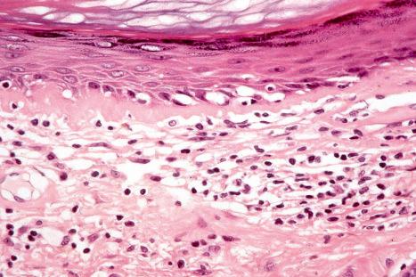 Fig. 17.51, Discoid lupus erythematosus: in this view there is hyperkeratosis, epidermal atrophy, and basal cell hydropic degeneration.