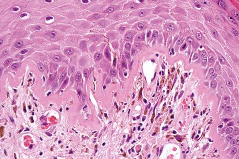 Fig. 17.52, Discoid lupus erythematosus: note the very marked thickening of the basement membrane and pigmentary incontinence.