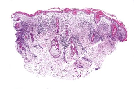 Fig. 17.47, Discoid lupus erythematosus: this scanning view shows hyperkeratosis, follicular plugging, an atrophic epidermis, and a perivascular and periadnexal chronic inflammatory cell infiltrate.