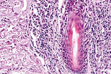 Fig. 17.48, Discoid lupus erythematosus: note the perifollicular lymphocytic infiltrate.