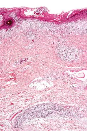 Fig. 17.50, Discoid lupus erythematosus: there is hyperkeratosis and atrophy of the epidermis.