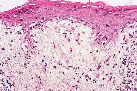 Fig. 17.55, Discoid lupus erythematosus: several cytoid bodies are present in the papillary dermis. Note the hydropic degeneration.