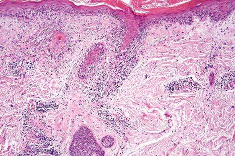 Fig. 17.58, Discoid lupus erythematosus: blood vessels and hair follicles are surrounded by a characteristic heavy lymphohistiocytic infiltrate.