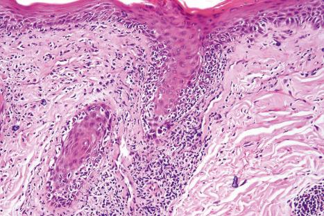 Fig. 17.59, Discoid lupus erythematosus: the follicular epithelium shows basal cell hydropic degeneration and there is a heavy lymphocytic infiltrate.