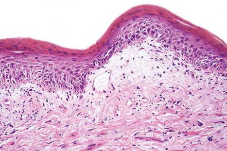 Fig. 17.60, Discoid lupus erythematosus: stromal mucin deposition, as seen in this field, is not uncommon.