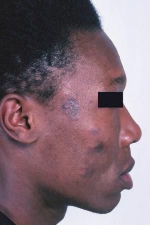 Fig. 17.6, Discoid lupus erythematosus: dark-skinned races are commonly affected.