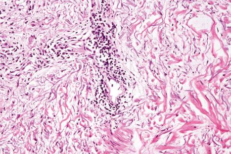 Fig. 17.61, Tumid discoid lupus erythematosus: in this rare variant, there is very marked mucin deposition.