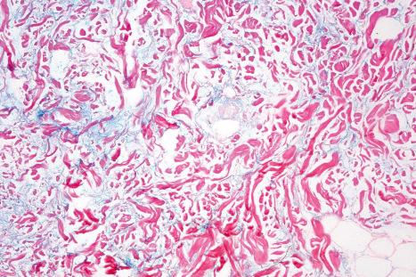 Fig. 17.62, Tumid discoid lupus erythematosus: the mucin stains with Alcian blue, pH 2.5.