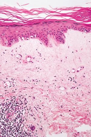 Fig. 17.65, Discoid lupus erythematosus: in this example, the presence of superficial dermal sclerosis is reminiscent of lichen sclerosus.