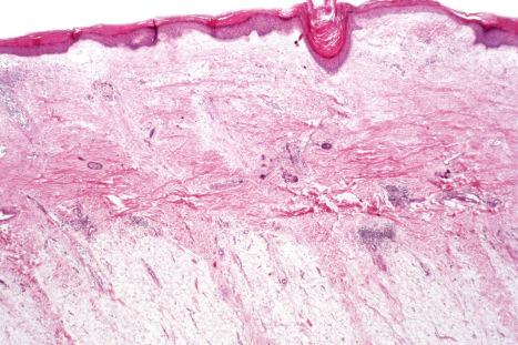 Fig. 17.66, Discoid lupus erythematosus: note the complete absence of hair follicles in this scalp specimen.