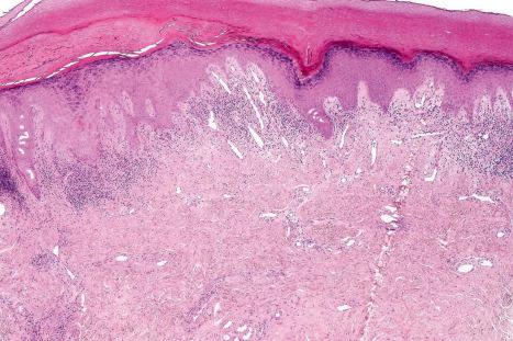 Fig. 17.67, Chilblain lupus erythematosus: there is irregular acanthosis and a superficial lymphocytic infiltrate. Ectatic vessels are conspicuous.