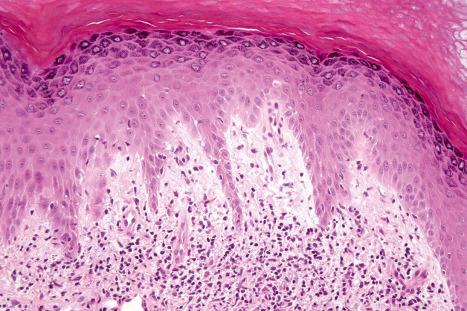 Fig. 17.68, Chilblain lupus erythematosus: in this field, there is marked edema of the papillary dermis.