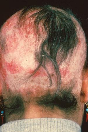 Fig. 17.7, Discoid lupus erythematosus: hair loss is permanent.