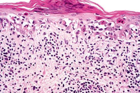 Fig. 17.73, Subacute cutaneous lupus erythematosus: note the presence of numerous cytoid bodies and focal satellite cell necrosis.