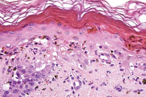 Fig. 17.74, Subacute cutaneous lupus erythematosus: in this example, there is marked basal cell hydropic degeneration and apoptosis. Only a patchy chronic inflammatory cell infiltrate is present.