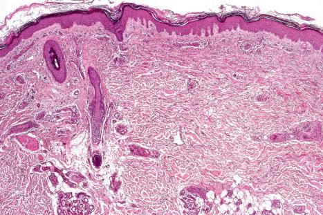 Fig. 17.77, Lupus anticoagulant syndrome: low-power view showing superficial blood vessels occluded by small thrombi.