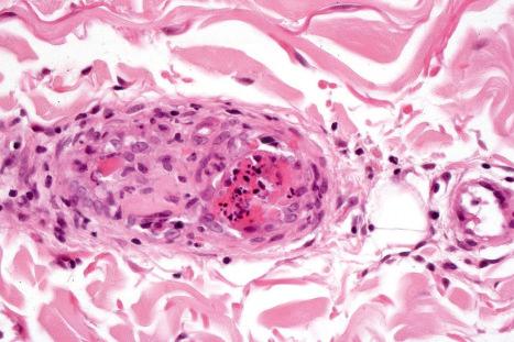 Fig. 17.78, Lupus anticoagulant syndrome: close-up view of occluded vessel – note the nuclear debris.